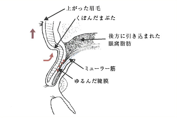 腱膜性眼瞼下垂時のまぶた（断面図）イメージ画像