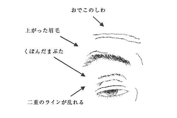 腱膜性眼瞼下垂イメージ画像