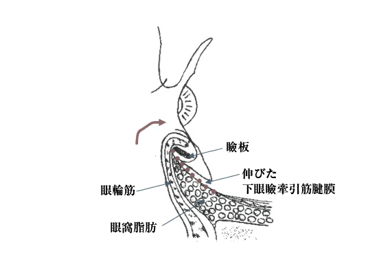 眼瞼内反症（断面図）イメージ画像
