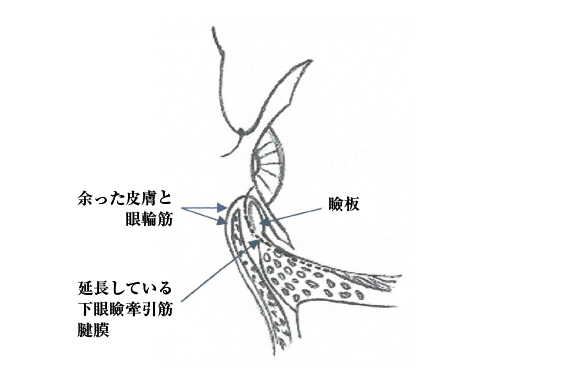 睫毛内反症（断面図）イメージ画像