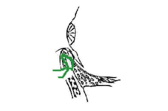 睫毛内反症矯正方法（2）